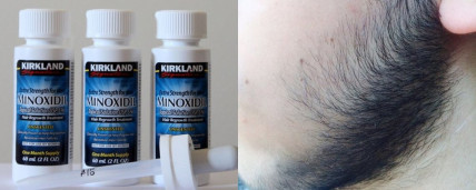 MINOXIDIL (Миноксидил) - средство для роста бороды